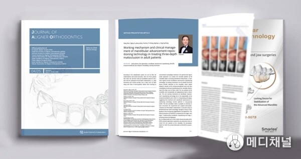 Prof. Gang Shen’s Research Paper about Mandibular Advancement Repositioning Technology in the Journal of Aligner Orthodontics
